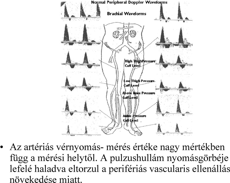 A pulzushullám nyomásgörbéje lefelé haladva