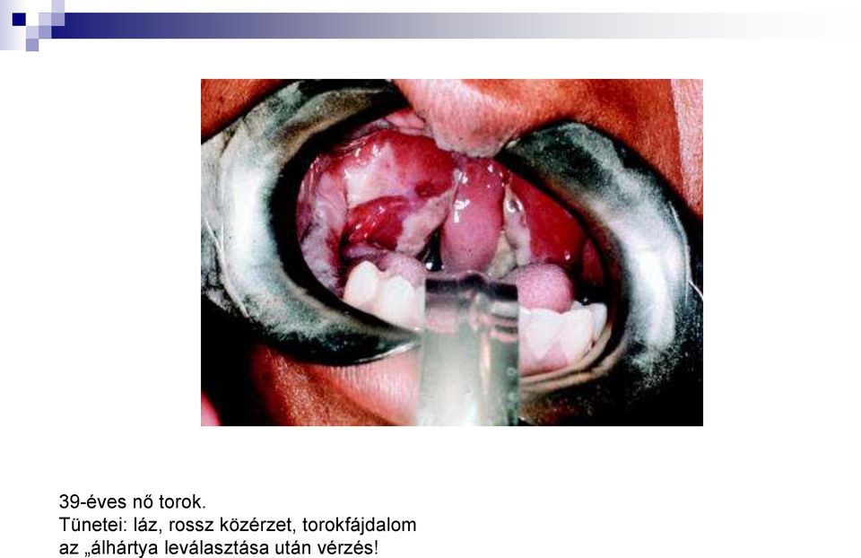 közérzet, torokfájdalom