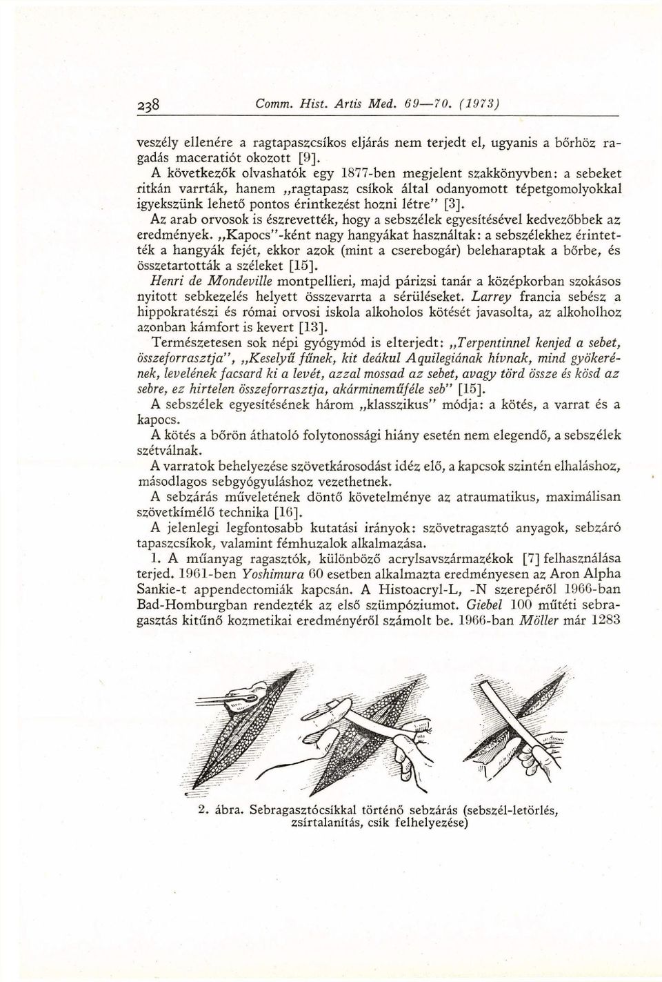 eredmények. Kapocs"-ként nagy hangyákat használtak: a sebszélekhez érintették a hangyák fejét, ekkor azok (mint a cserebogár) beleharaptak a bőrbe, és összetartották a széleket [15].