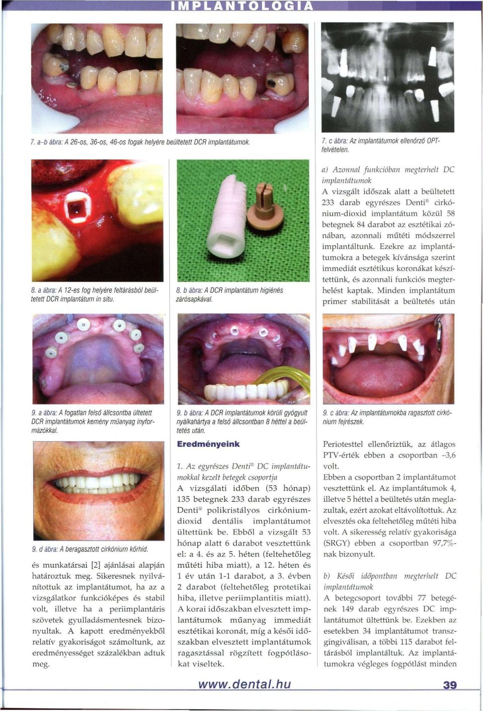 a) Azonnal funkcióban megterhelt DC implantátumok A vizsgált időszak alatt a beültetett 233 darab egyrészes Denti cirkónium-dioxid implantátum közül 58 betegnek 84 darabot az esztétikai zónában,