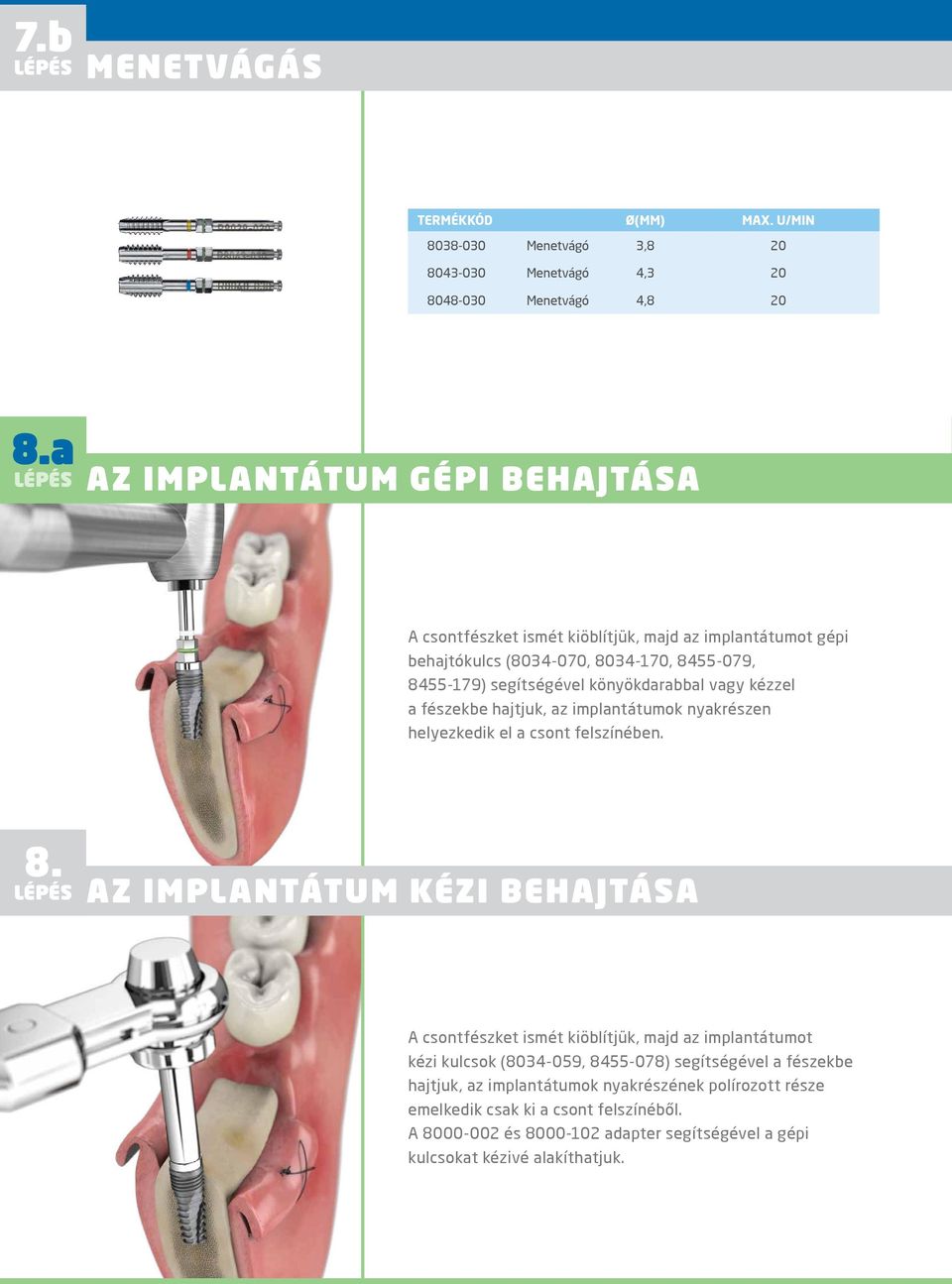 könyökdarabbal vagy kézzel a fészekbe hajtjuk, az implantátumok nyakrészen helyezkedik el a csont felszínében. 8.