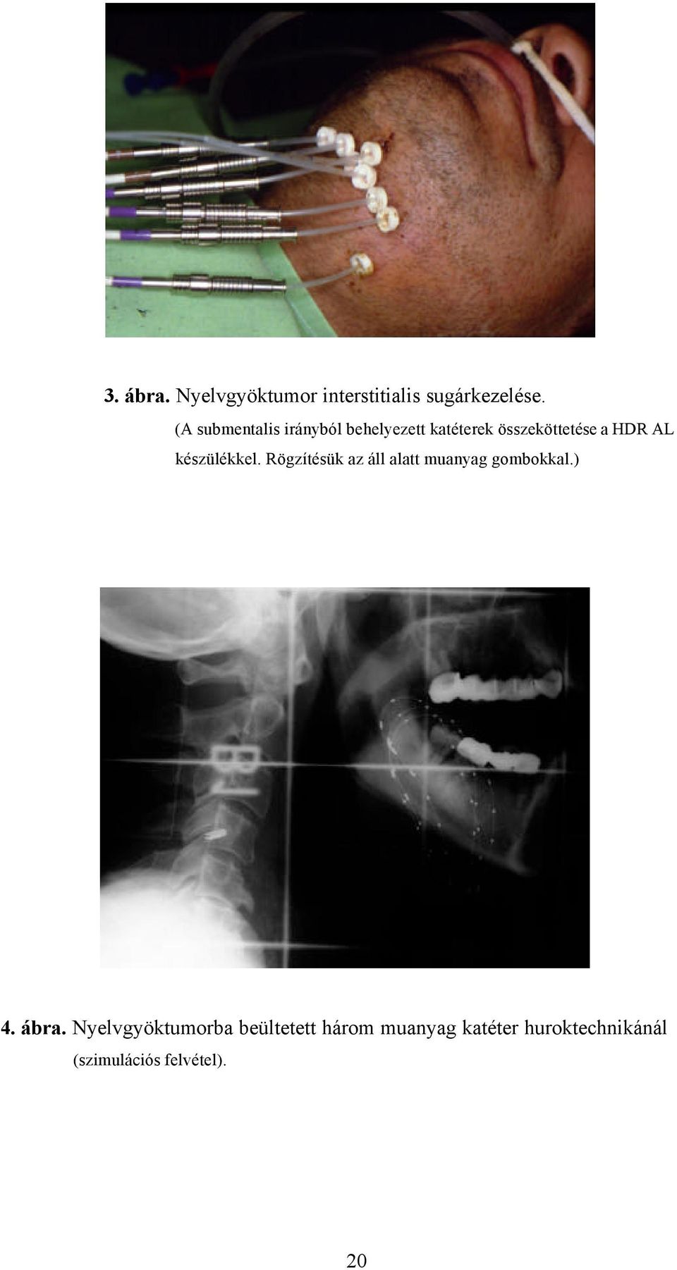 készülékkel. Rögzítésük az áll alatt muanyag gombokkal.) 4. ábra.