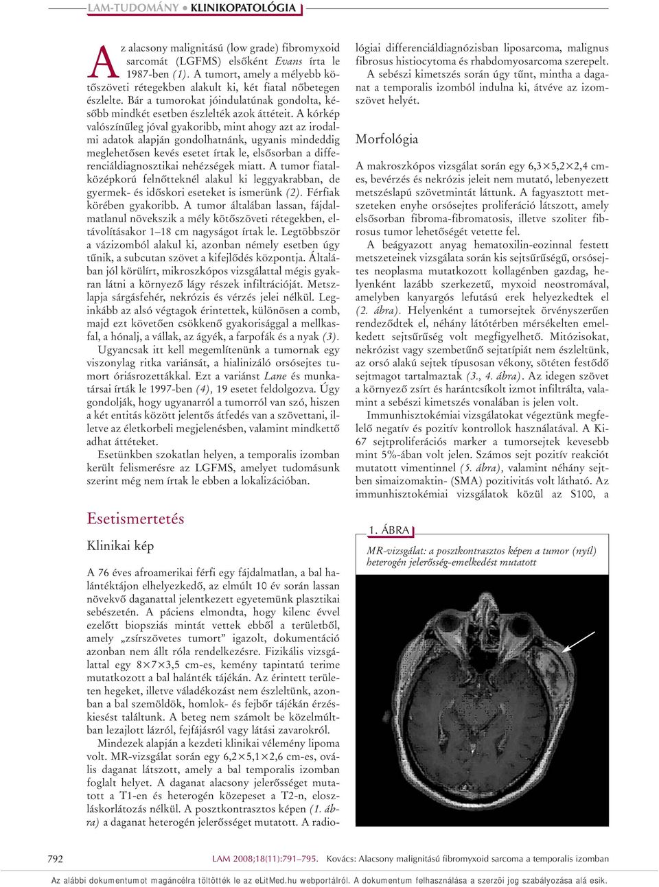 A kórkép valószínûleg jóval gyakoribb, mint ahogy azt az irodalmi adatok alapján gondolhatnánk, ugyanis mindeddig meglehetôsen kevés esetet írtak le, elsôsorban a differenciáldiagnosztikai nehézségek