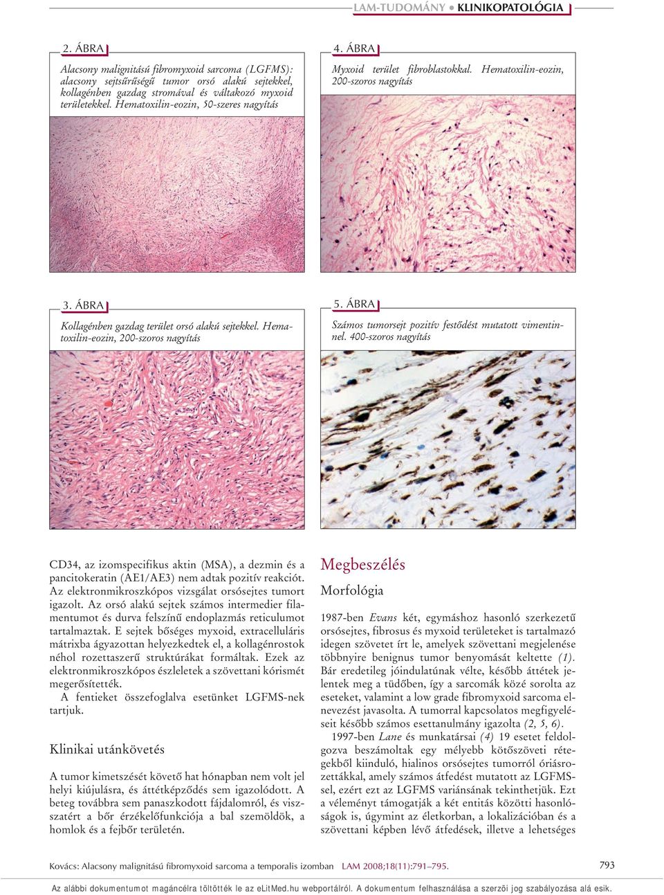 Hematoxilin-eozin, 200-szoros nagyítás 5. ÁBRA Számos tumorsejt pozitív festôdést mutatott vimentinnel.