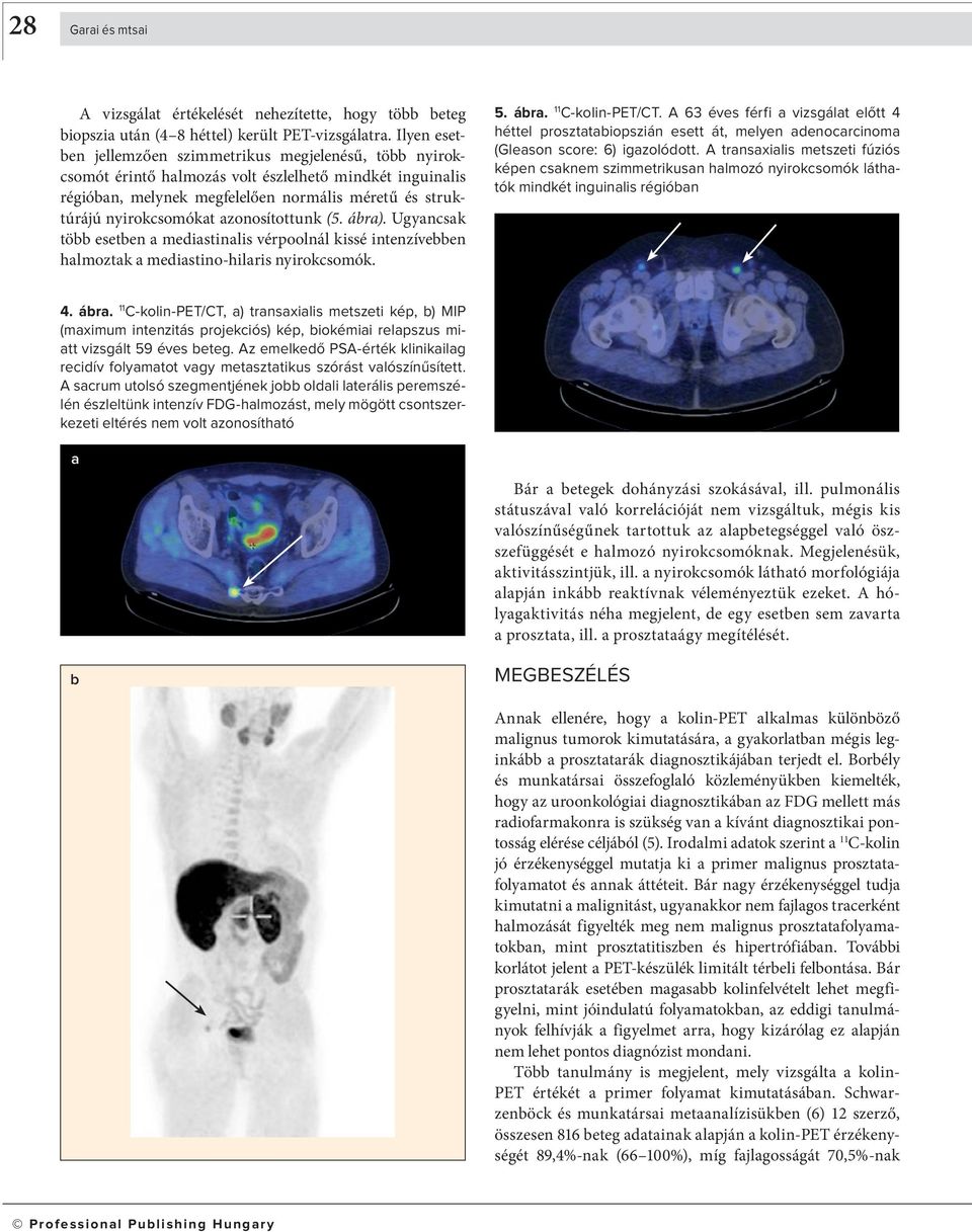 zonosítottunk (5. ár). Ugyncsk tö eseten medistinlis vérpoolnál kiss é intenzíveen hlmoztk medistino-hilris nyirok csomók. 5. ár. C-kolin-PET/CT.