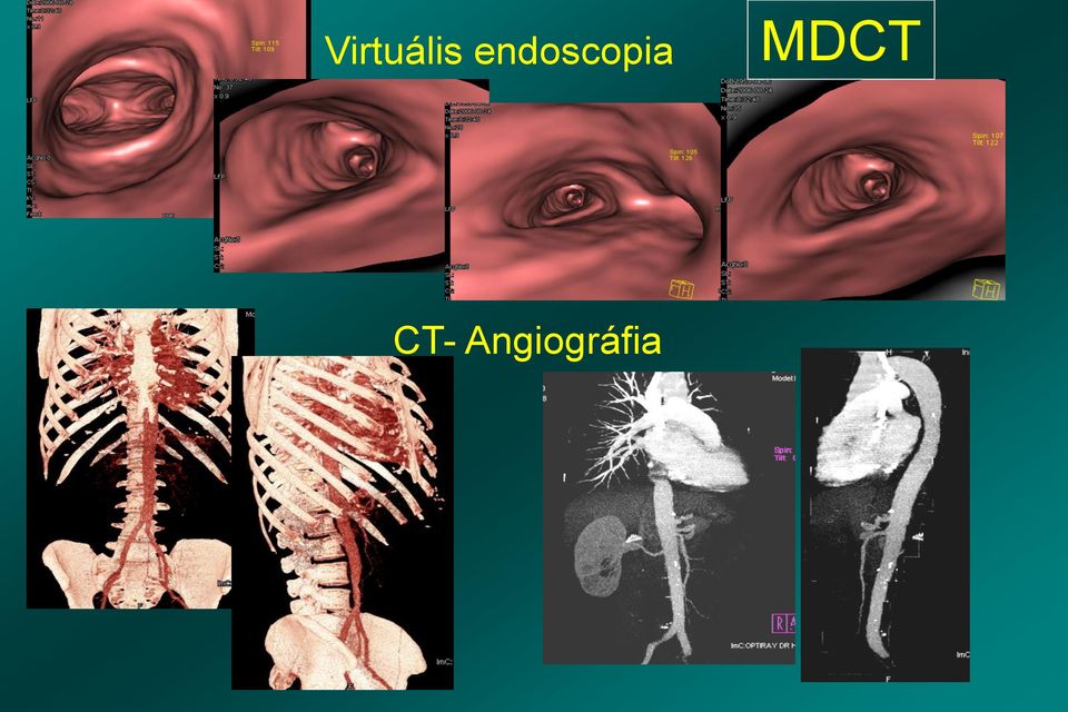 MDCT CT-