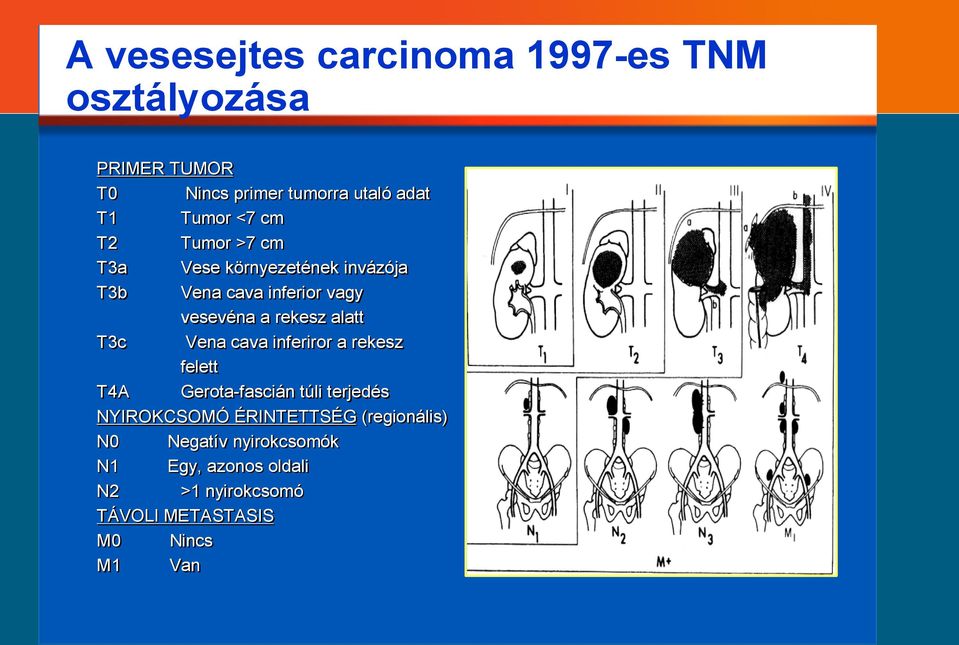 alatt T3c Vena cava inferiror a rekesz felett T4A Gerota-fascián túli terjedés NYIROKCSOMÓ ÉRINTETTSÉG