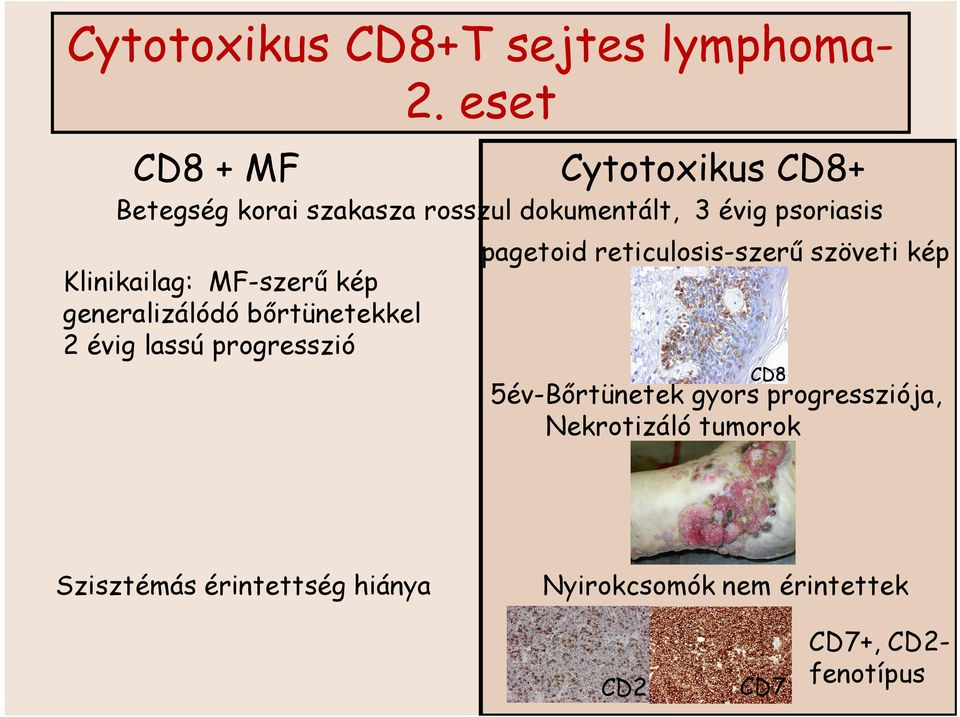 pagetoid reticulosis-szerű szöveti kép Klinikailag: MF-szerű kép generalizálódó bőrtünetekkel 2