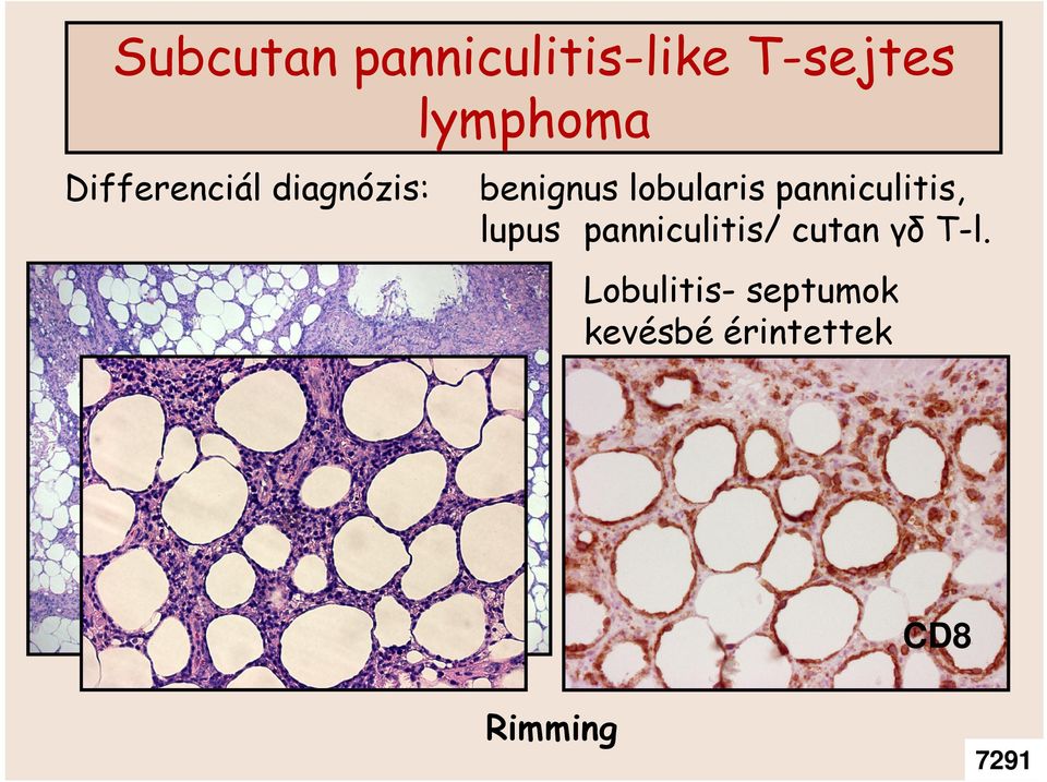 panniculitis, lupus panniculitis/ cutan γδ T-l.