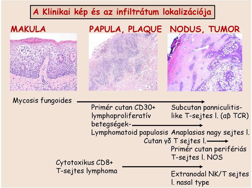 (αβ TCR) lymphoproliferatív betegségeklymphomatoid papulosis Anaplasias nagy sejtes l.