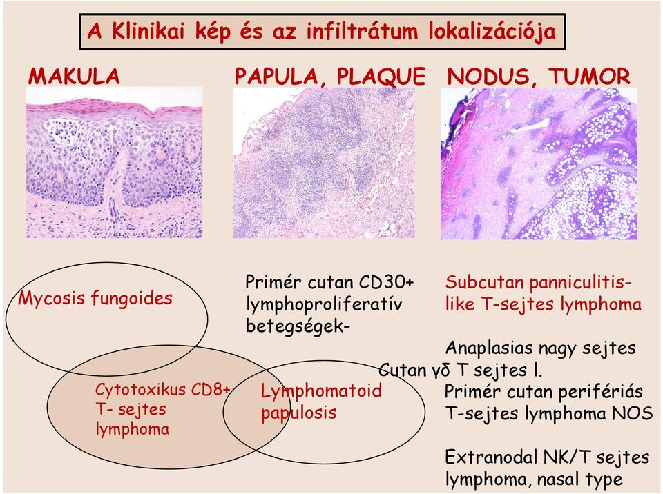 Subcutan panniculitislike T-sejtes lymphoma Anaplasias nagy sejtes Cutan γδ T sejtes l.