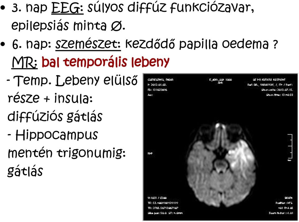 MR: bal temporális lebeny - Temp.