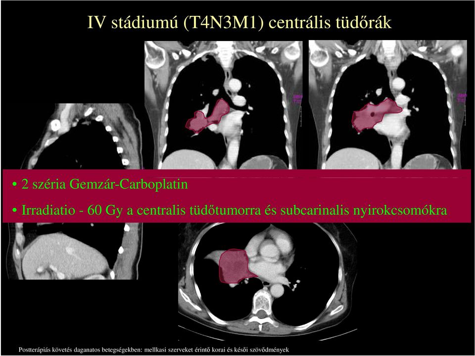 Gemzár-Carboplatin Irradiatio - 60