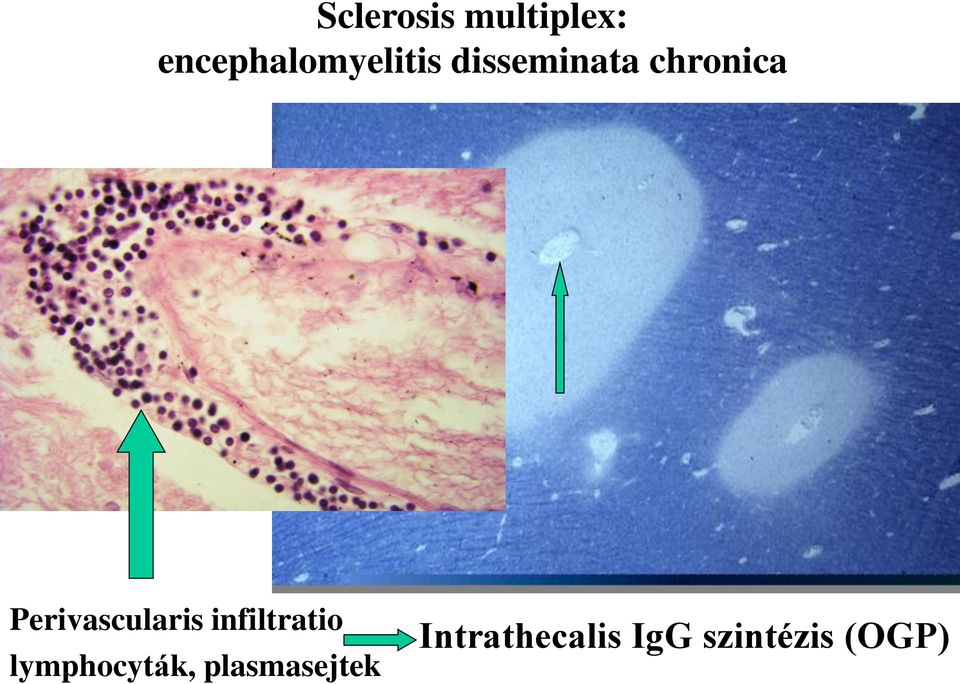 chronica Perivascularis infiltratio