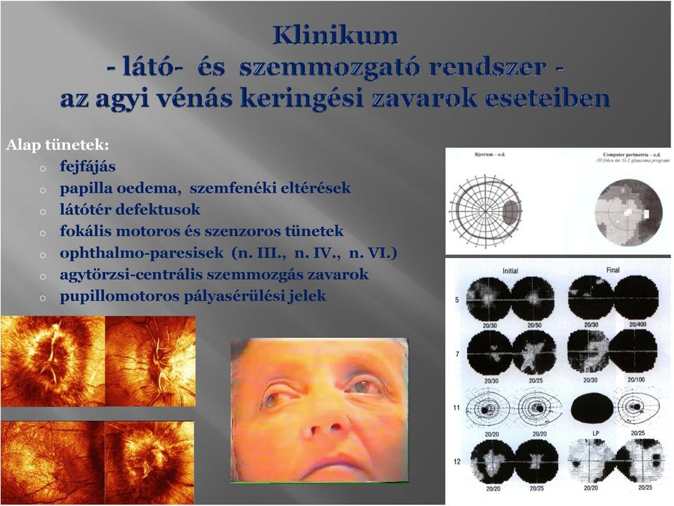 tünetek phthalm-paresisek (n. III., n. IV., n. VI.