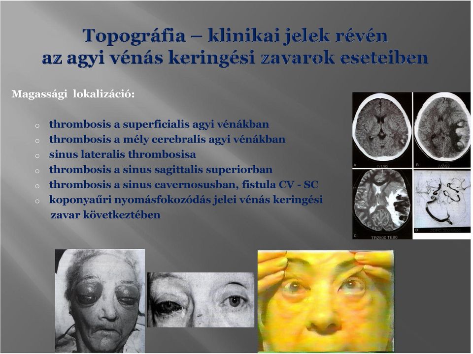 sinus sagittalis superirban thrmbsis a sinus cavernsusban, fistula CV