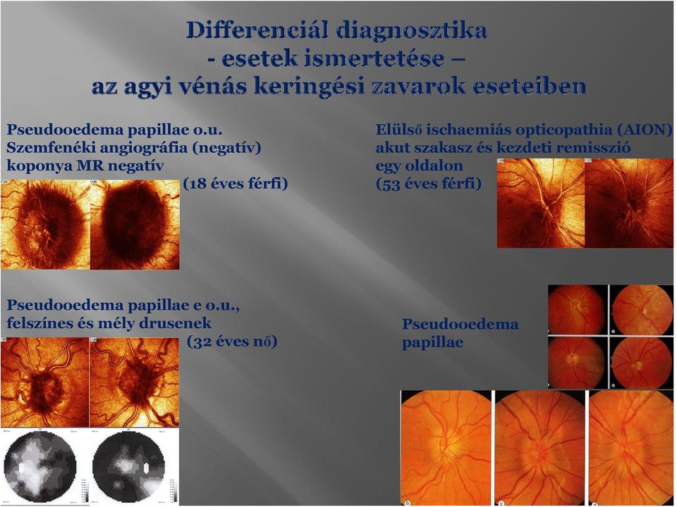 szakasz és kezdeti remisszió egy ldaln (53 éves férfi) Pseudedema