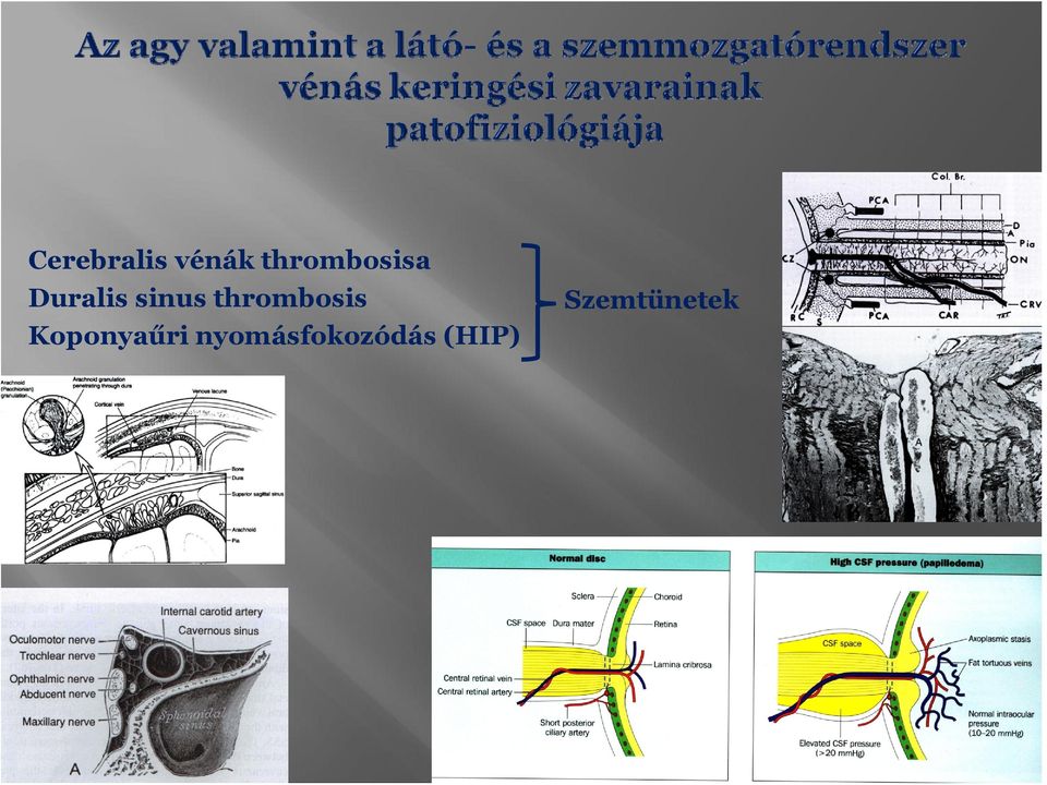 sinus thrmbsis