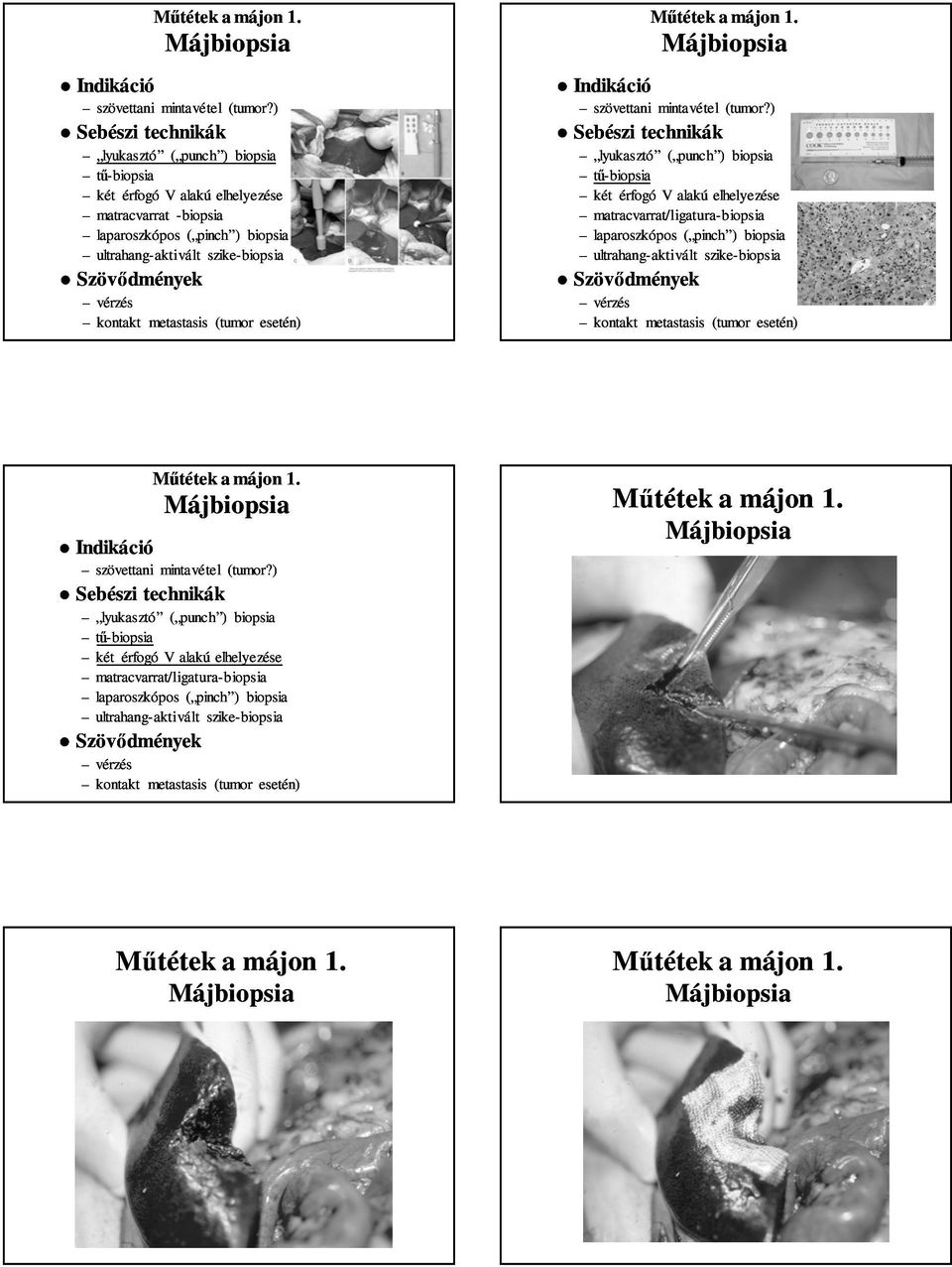 (tumor esetén) ) Sebészi technikák lyukasztó ( punch punch ) tű- két érfogó V alakú elhelyezése matracvarrat/ligatura ligatura- laparoszkópos ( pinch pinch )
