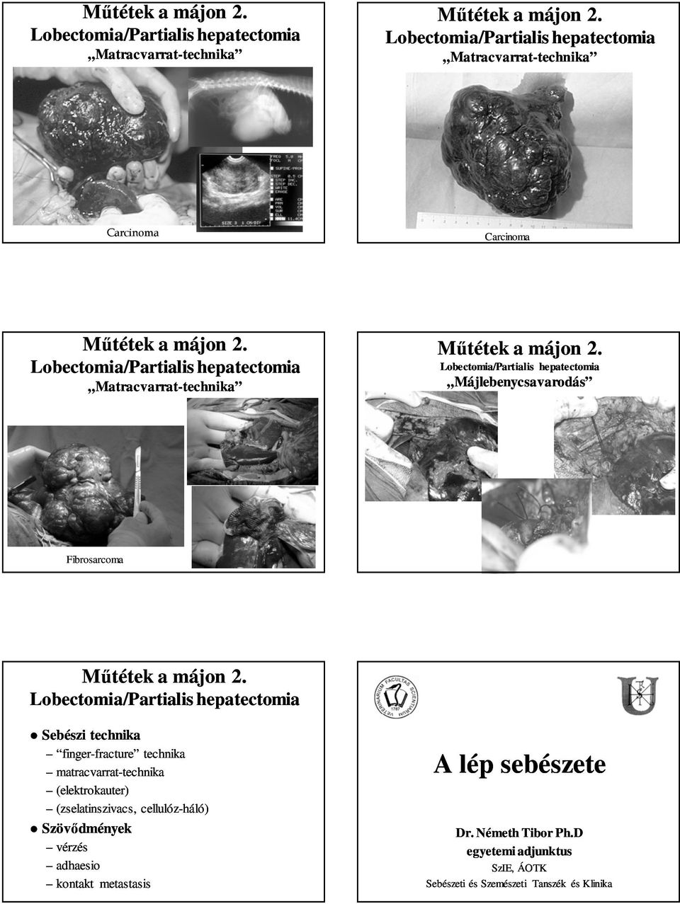 (zselatinszivacs, cellulóz-háló) adhaesio kontakt metastasis A lép sebészete