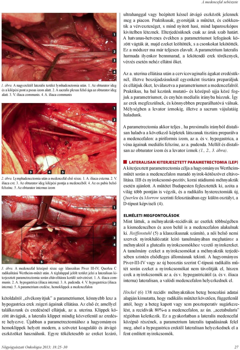 . Az os pubis belső felszíne. 5. Az obturator internus izom 5 5. ábra. A medencefal középső része egy klasszikus Piver III-IV, Querleu C radikalitású Wertheim-műtét után.