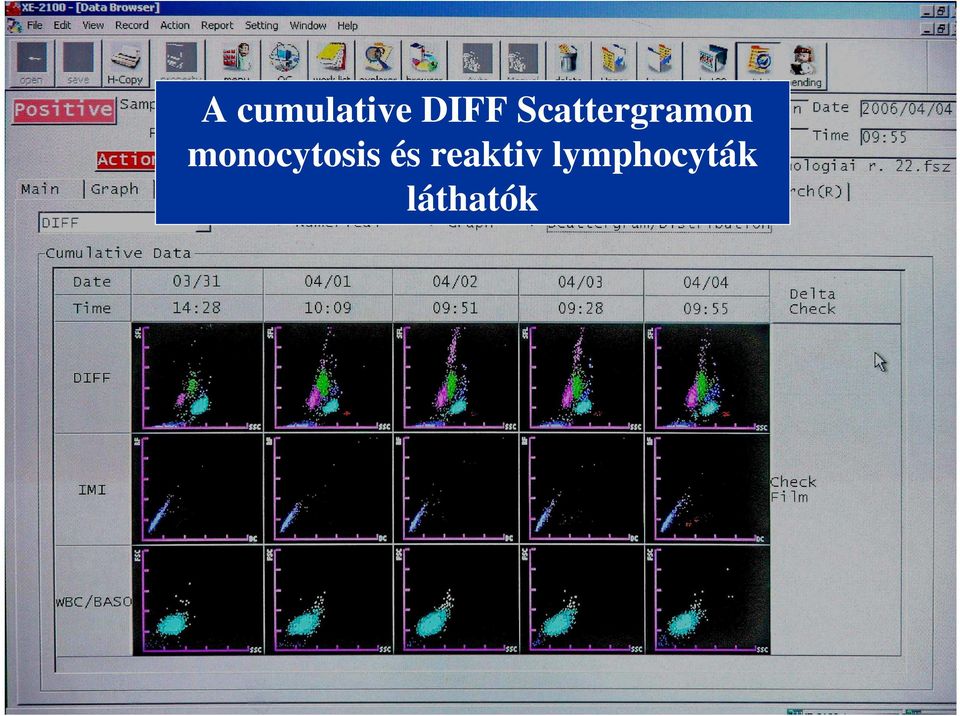 monocytosis és