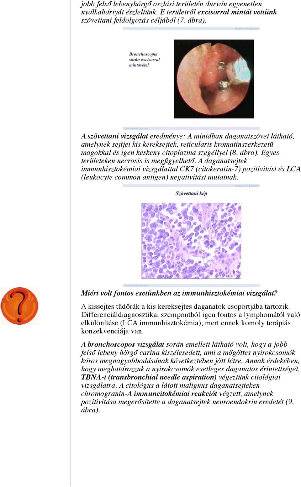 Egyes területeken necrosis is megfigyelhető. A daganatsejtek immunhisztokémiai vizsgálattal CK7 (citokeratin-7) pozitivitást és LCA (leukocyte common antigen) negativitást mutatnak.