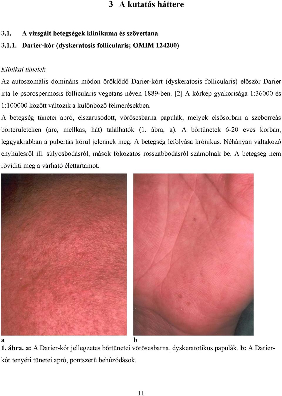 1. Darier-kór (dyskeratosis follicularis; OMIM 124200) Klinikai tünetek Az autoszomális domináns módon öröklődő Darier-kórt (dyskeratosis follicularis) először Darier írta le psorospermosis