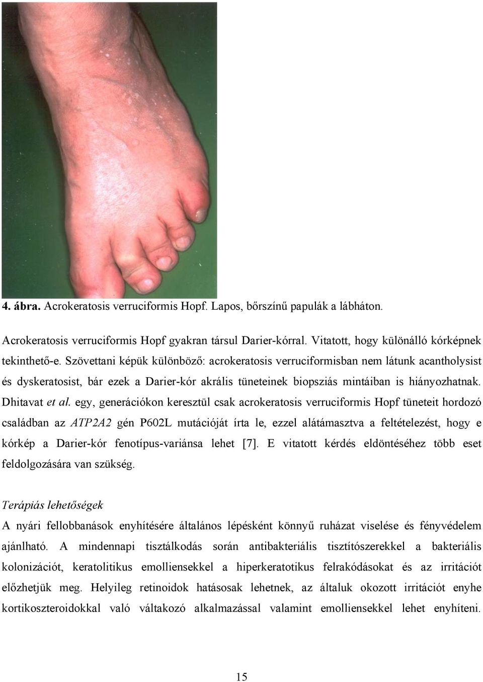 egy, generációkon keresztül csak acrokeratosis verruciformis Hopf tüneteit hordozó családban az ATP2A2 gén P602L mutációját írta le, ezzel alátámasztva a feltételezést, hogy e kórkép a Darier-kór