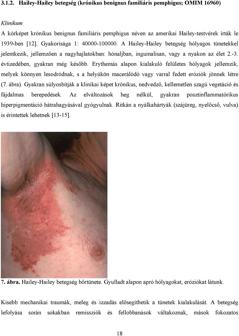 évtizedében, gyakran még később. Erythemás alapon kialakuló felületes hólyagok jellemzik, melyek könnyen lesodródnak, s a helyükön macerálódó vagy varral fedett eróziók jönnek létre (7. ábra).