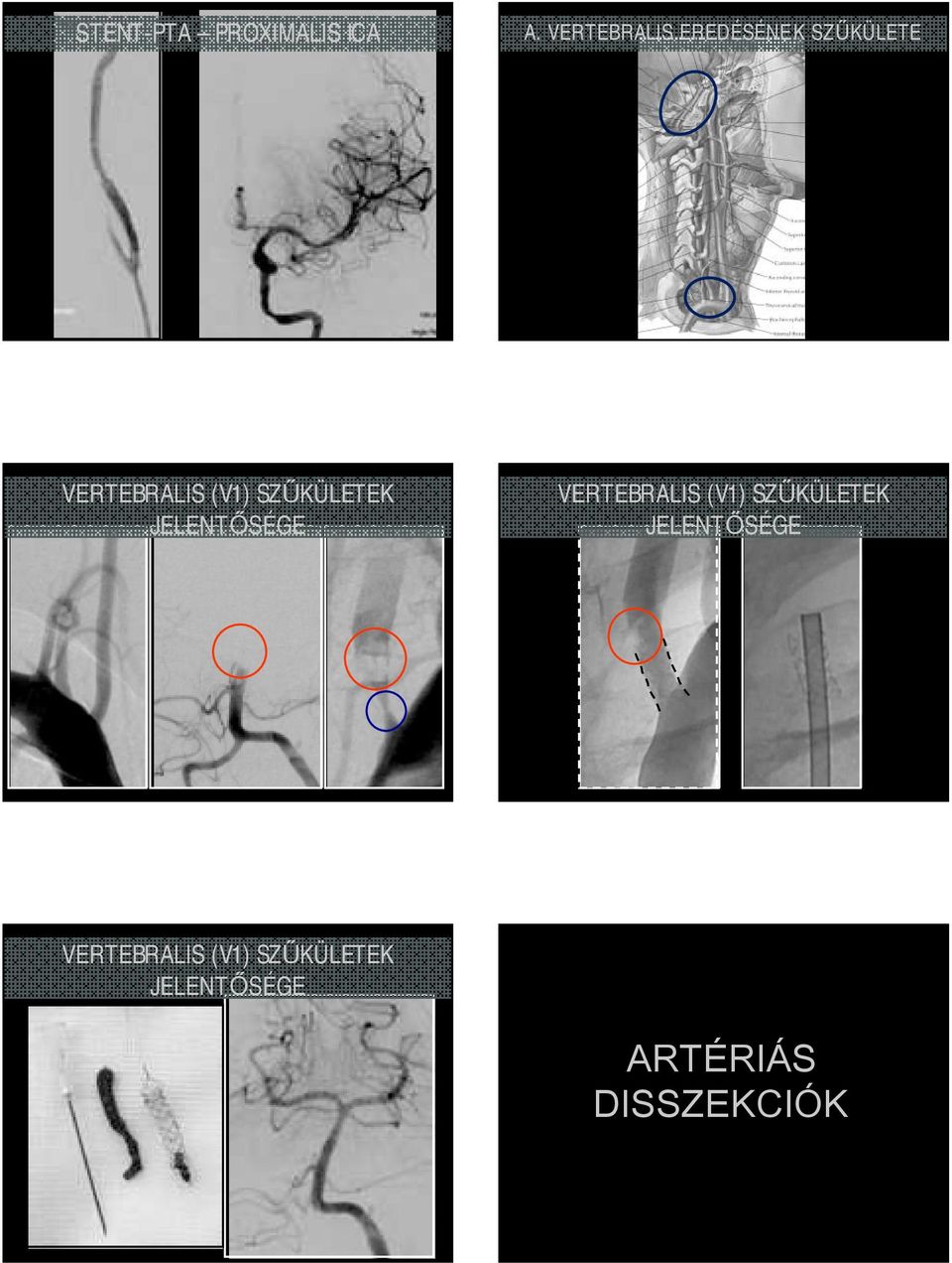 SZŰKÜLETEK JELENTŐSÉGE VERTEBRALIS (V1) SZŰKÜLETEK