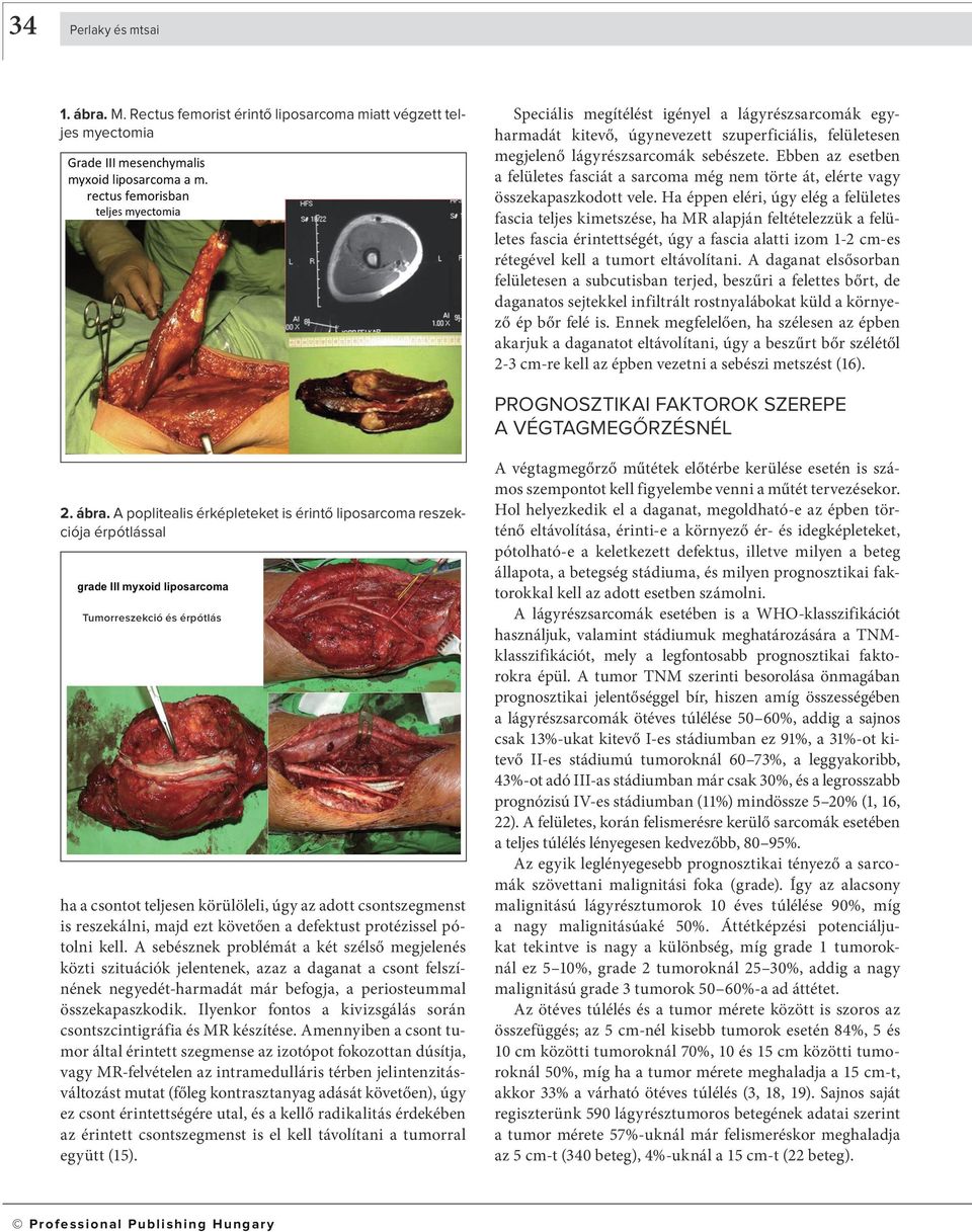 lágyrészsarcomák sebészete. Ebben az esetben a felületes fasciát a sarcoma még nem törte át, elérte vagy összekapaszkodott vele.