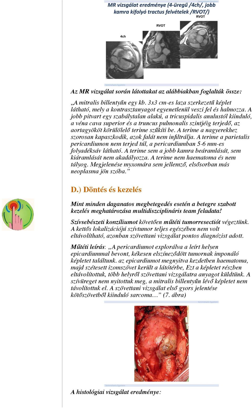 A terime a nagyerekhez szorosan kapaszkodik, azok falát nem infiltrálja. A terime a parietalis pericardiumon nem terjed túl, a pericardiumban 5-6 mm-es folyadéksáv látható.