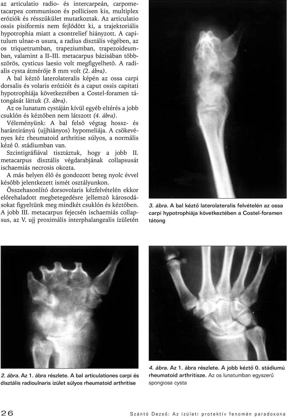 A capitulum ulnae-n usura, a radius disztális végében, az os triquetrumban, trapeziumban, trapezoideumban, valamint a II III. metacarpus bázisában többszörös, cysticus laesio volt megfigyelhetô.