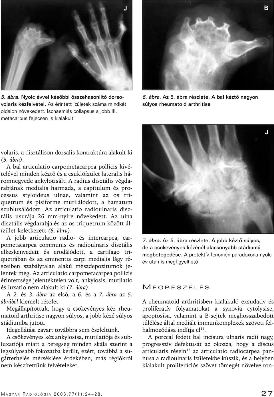 A bal articulatio carpometacarpea pollicis kivételével minden kéztô és a csuklóízület lateralis háromnegyede ankylotisált.