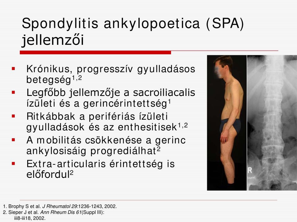 1,2 A mobilitás csökkenése a gerinc ankylosisáig progrediálhat 2 Extra-articularis érintettség is előfordul 2 1.