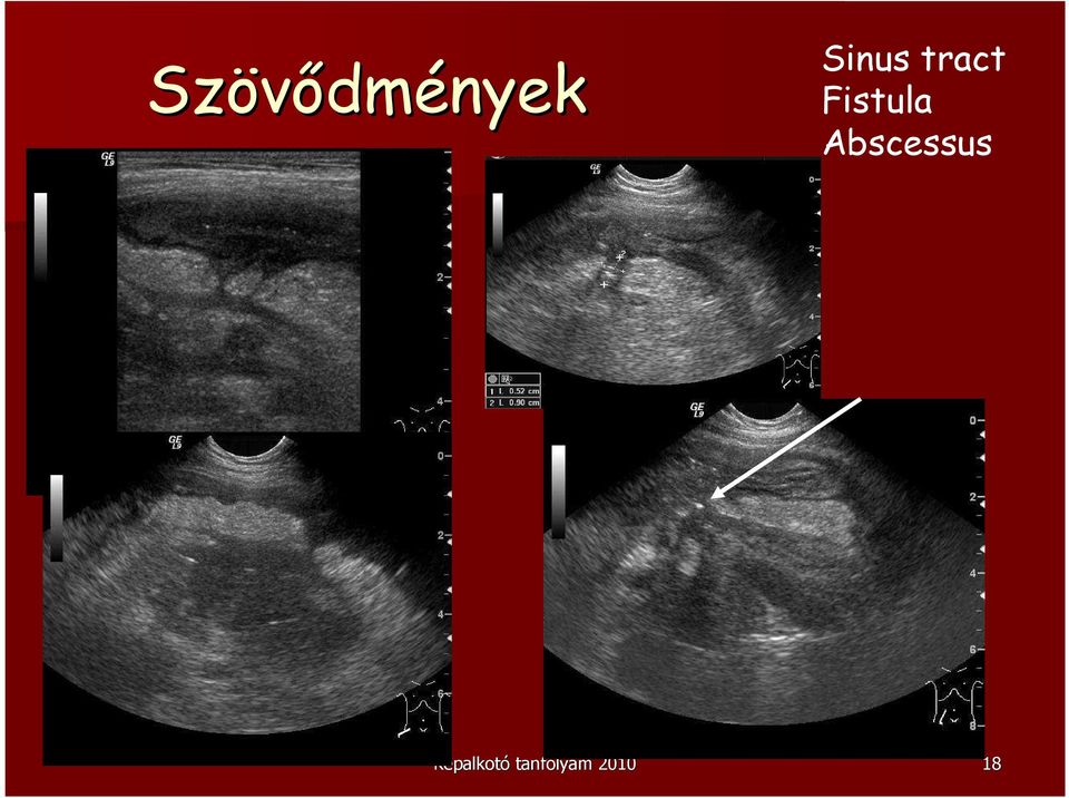 Fistula Abscessus