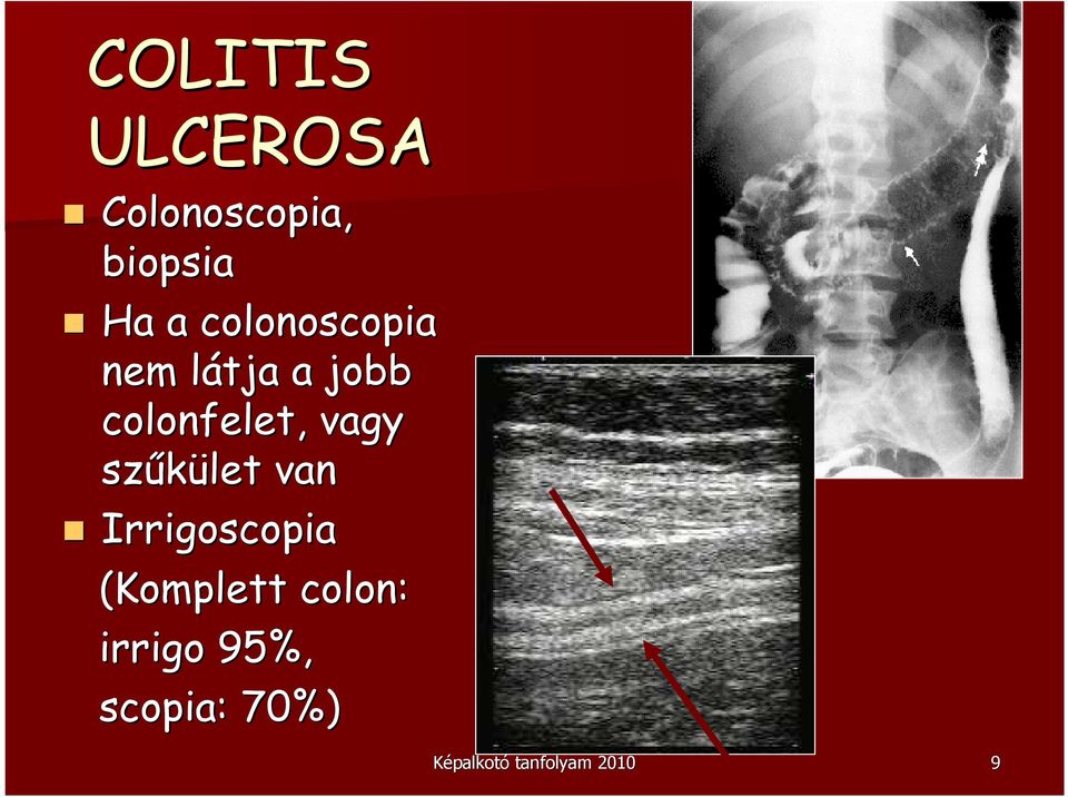 vagy szőkület van Irrigoscopia (Komplett colon: