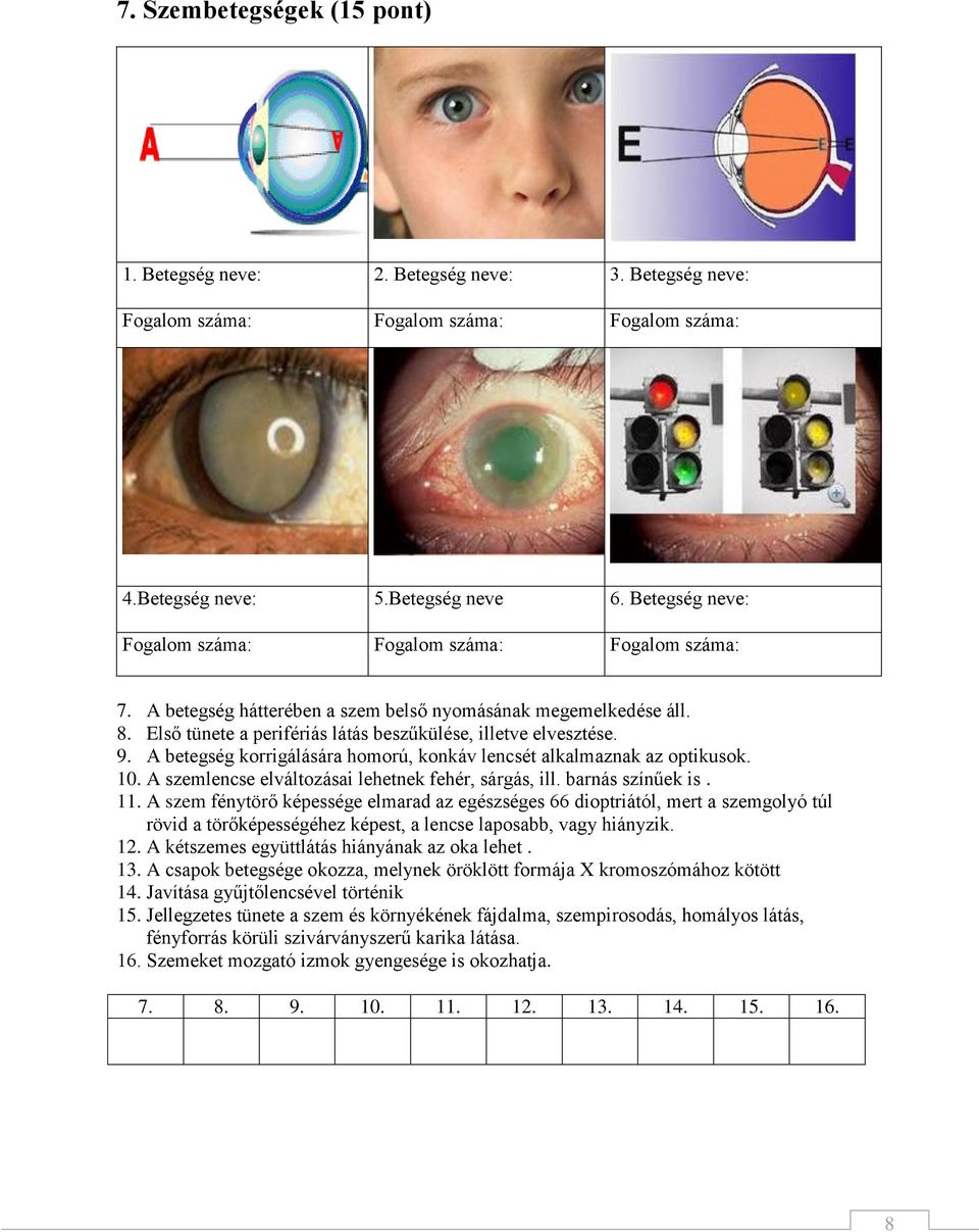 A betegség korrigálására homorú, konkáv lencsét alkalmaznak az optikusok. 10. A szemlencse elváltozásai lehetnek fehér, sárgás, ill. barnás színűek is. 11.