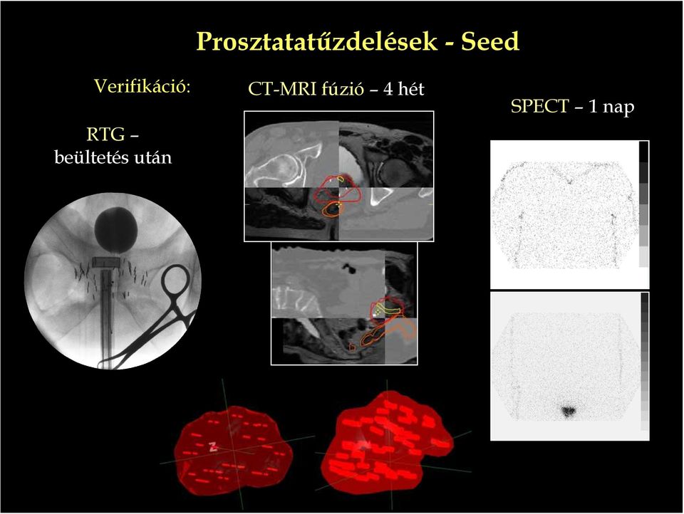 beültetés után CT-MRI