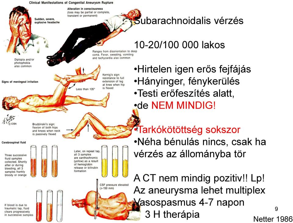 Tarkókötöttség sokszor Néha bénulás nincs, csak ha vérzés az állományba tör A