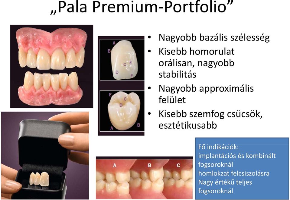 szemfog csücsök, esztétikusabb Fő ő indikációk: iók implantációs és