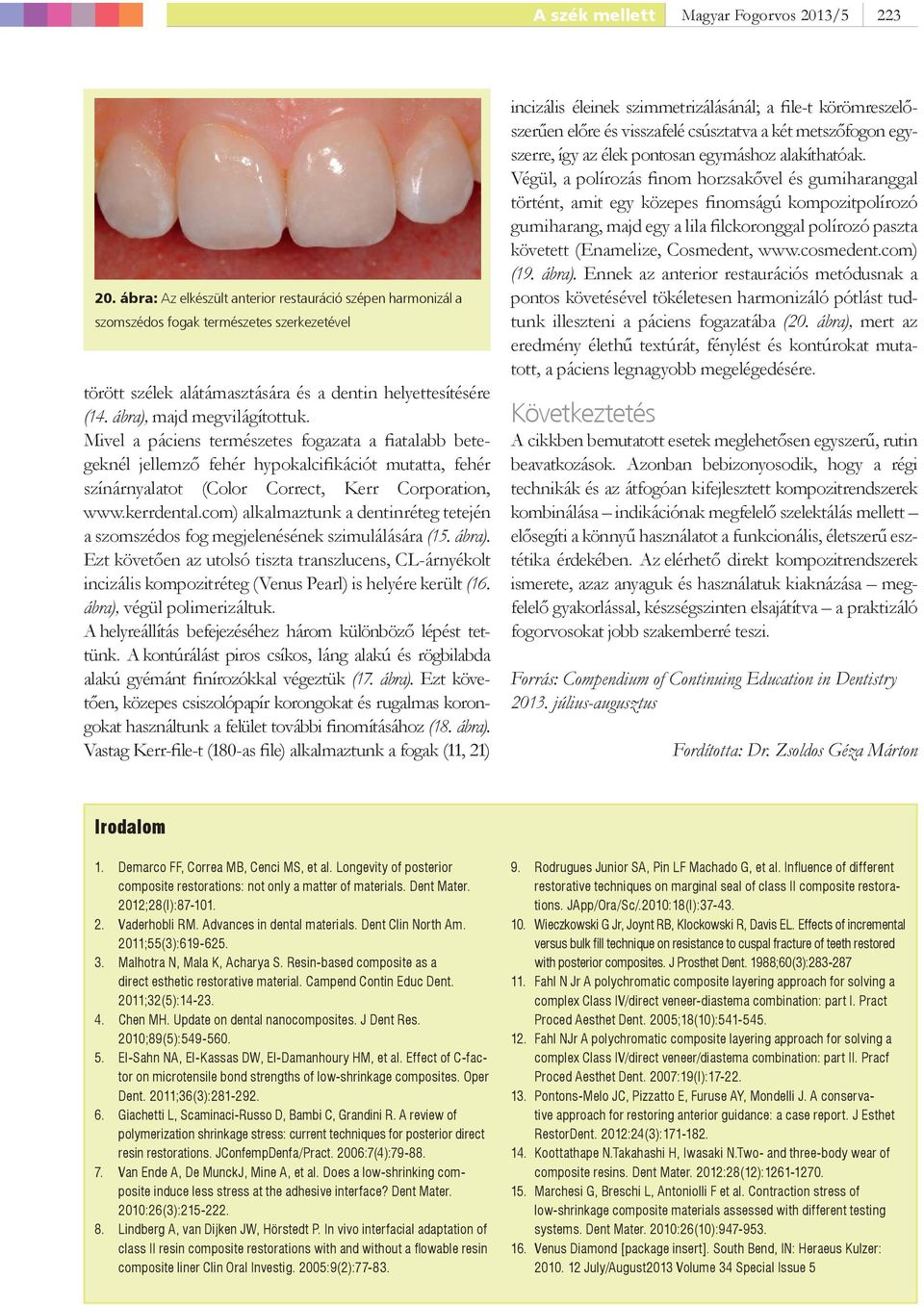 Mivel a páciens természetes fogazata a fiatalabb betegeknél jellemző fehér hypokalcifikációt mutatta, fehér színárnyalatot (Color Correct, Kerr Corporation, www.kerrdental.