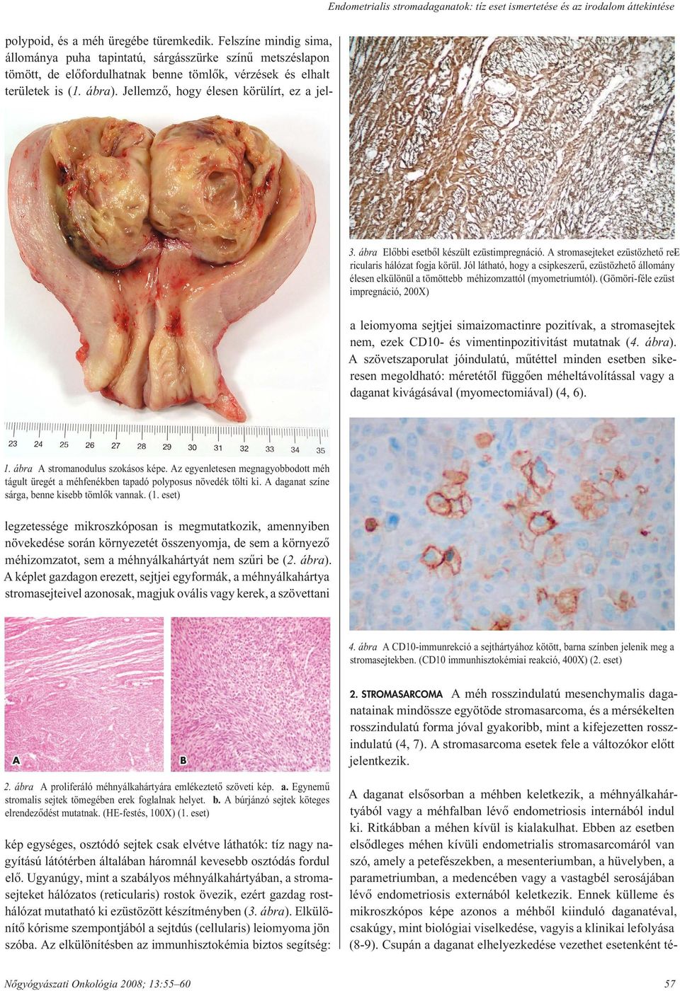 (Gömöri-féle ezüst impregnáció, 200X) a leiomyoma sejtjei simaizomactinre pozitívak, a stro ma sej tek nem, ezek CD10- és vi men tin po zi ti vi tást mutatnak (4. ábra).