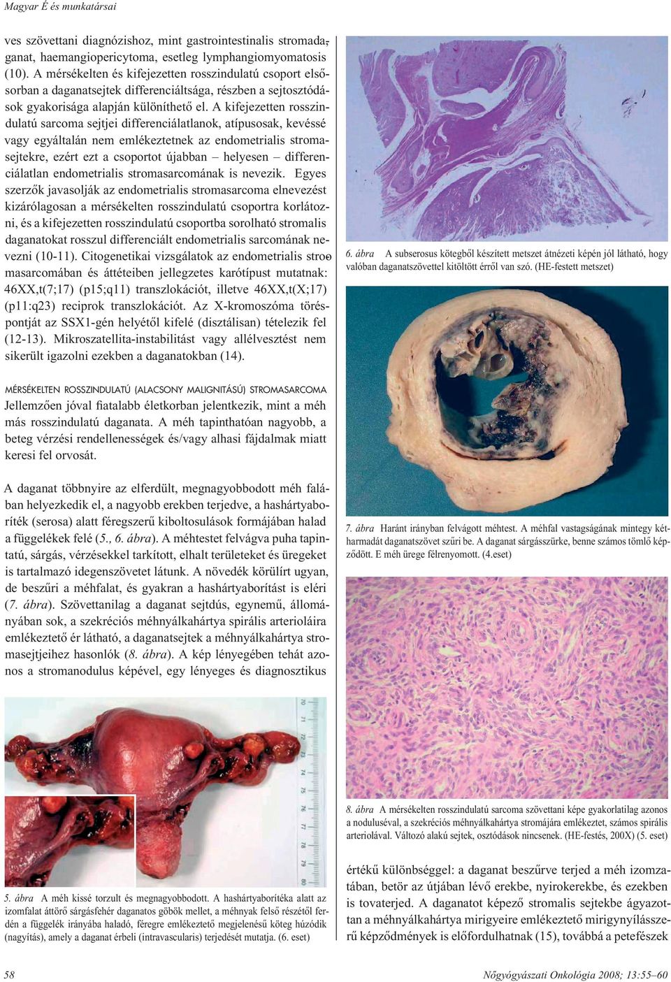 A kifejezetten rosszindulatú sarcoma sejtjei differenciálatlanok, atípusosak, kevéssé vagy egyáltalán nem emlékeztetnek az endometrialis stro masej tek re, ezért ezt a csoportot újabban helyesen