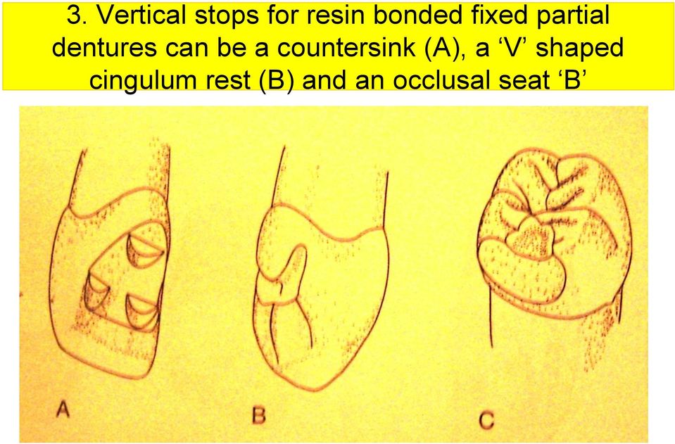 be a countersink (A), a V shaped