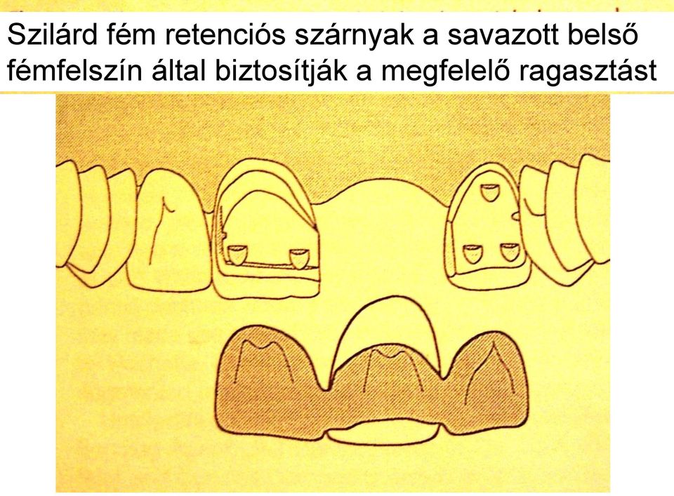 belső fémfelszín által