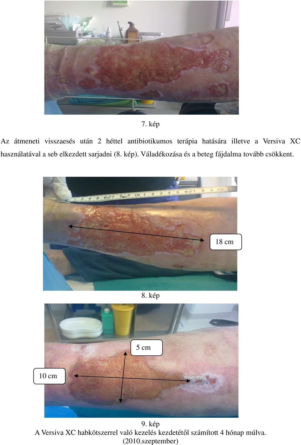 Váladékozása és a beteg fájdalma tovább csökkent. 18 cm 8. kép 5 cm 10 cm 9.