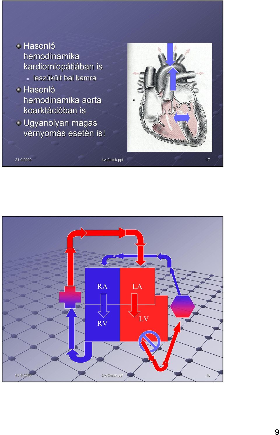 hemodinamika aorta koarktációban is