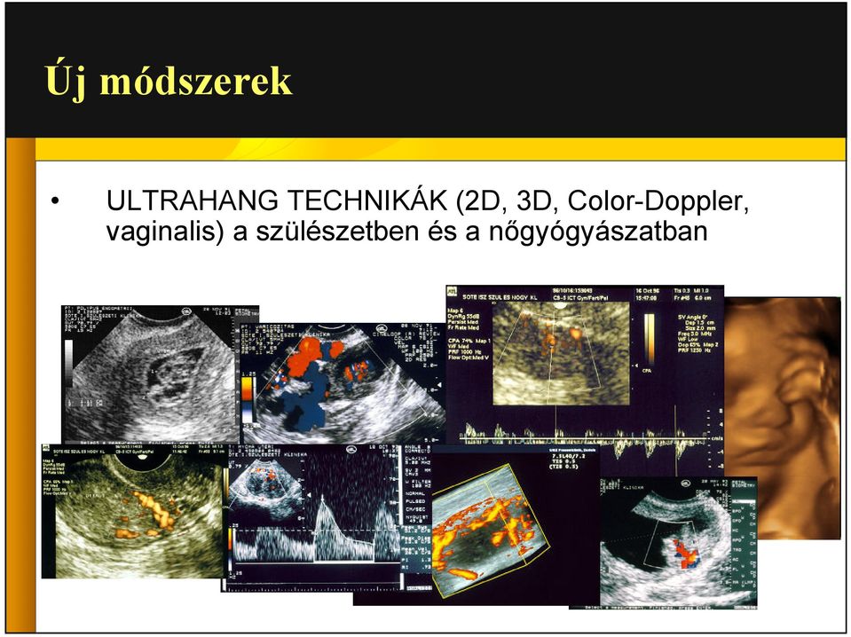 Color-Doppler, vaginalis)